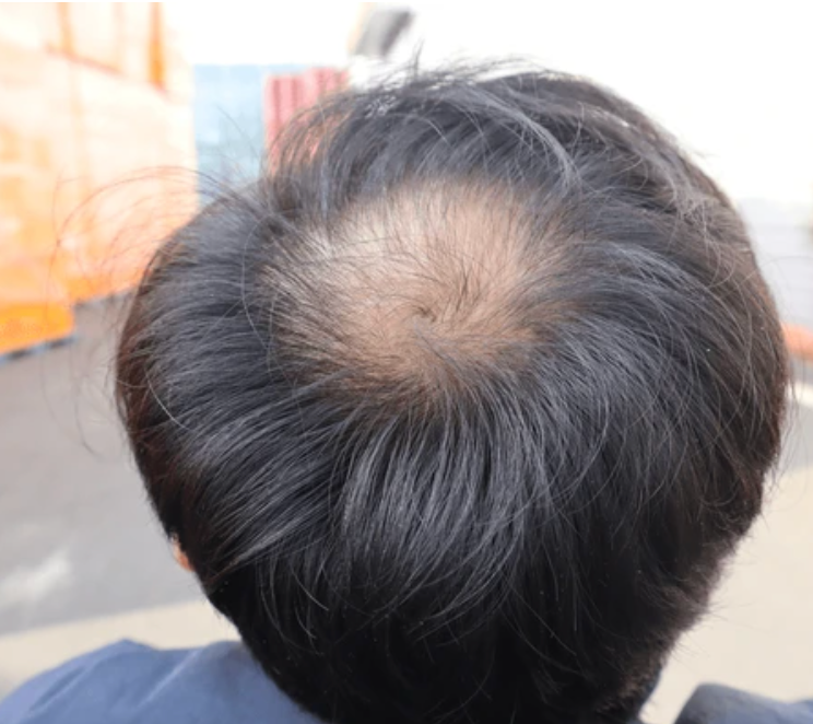 Formula capilar anticaída de cabello