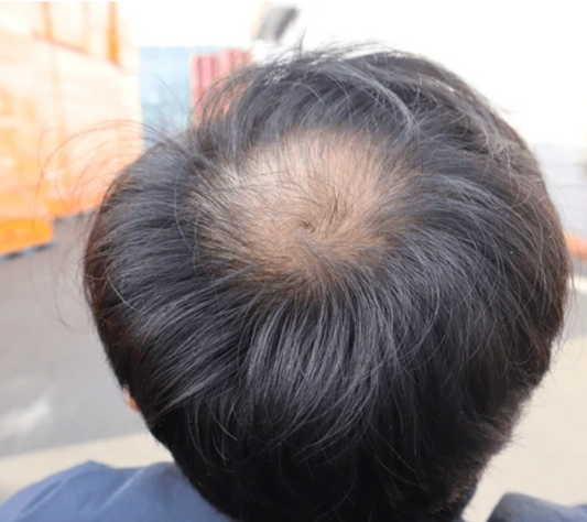 Formula capilar anticaída de cabello